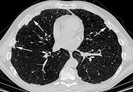 MRI Image Showing Lungs Affected By Disease