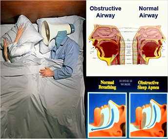 Sleep Apnea Infographic Sleep Apnea Infographic