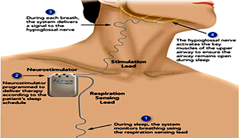 Inspire Upper Airway Stimulation (UAS) Infographic Inspire Upper Airway Stimulation (UAS) Infographic